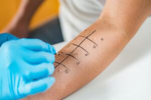 Doctor conducting an allergy test on patient's arm